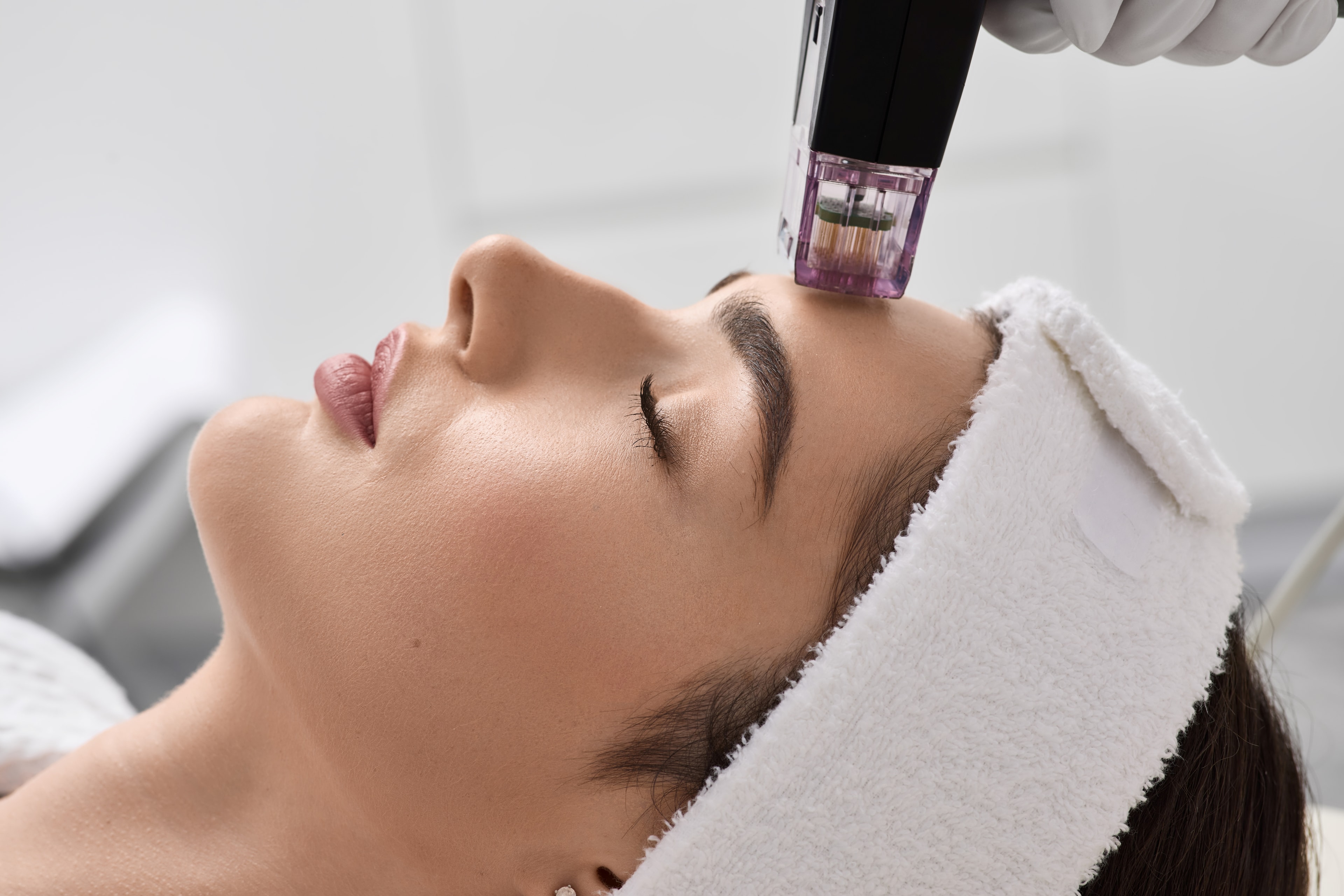 Professionelles Microneedling in St. Gallen